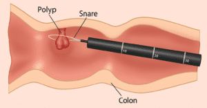 case against colonoscopies