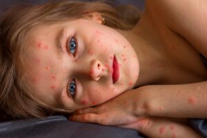 measles outbreak